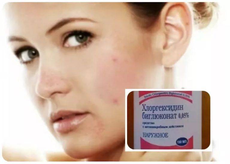 Хлоргексидин от прыщей
