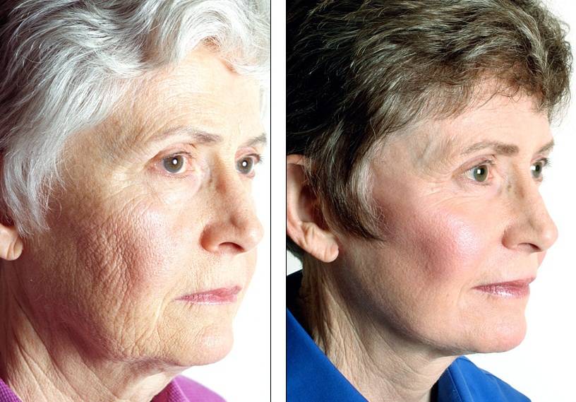 Феноловый пилинг: модификации, состав, применение | портал 1nep.ru