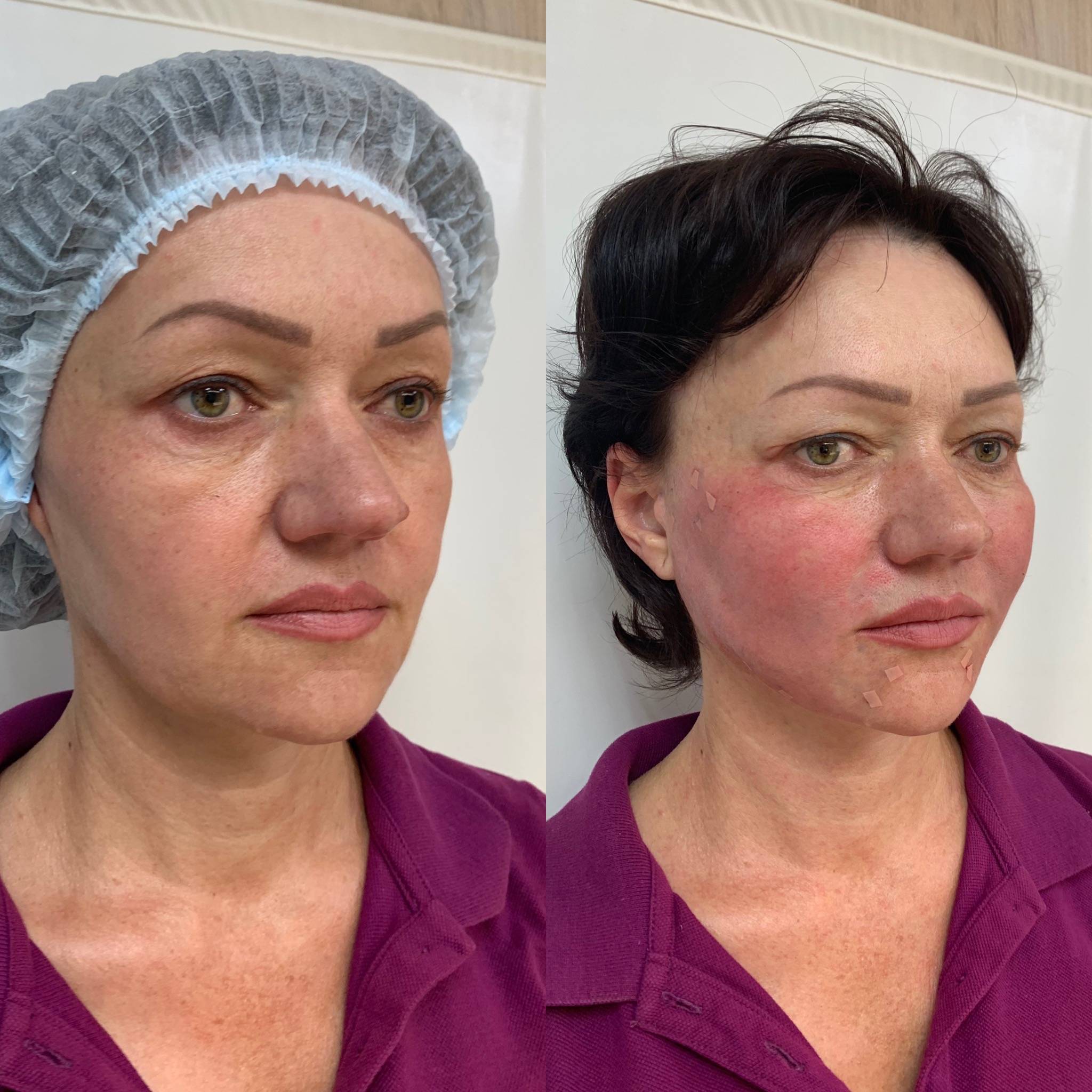 Нити аптос: что это такое, чем отличается от других видов подтяжки лица, что лучше aptos или коги, силуэт лифт, софт, какова цена?