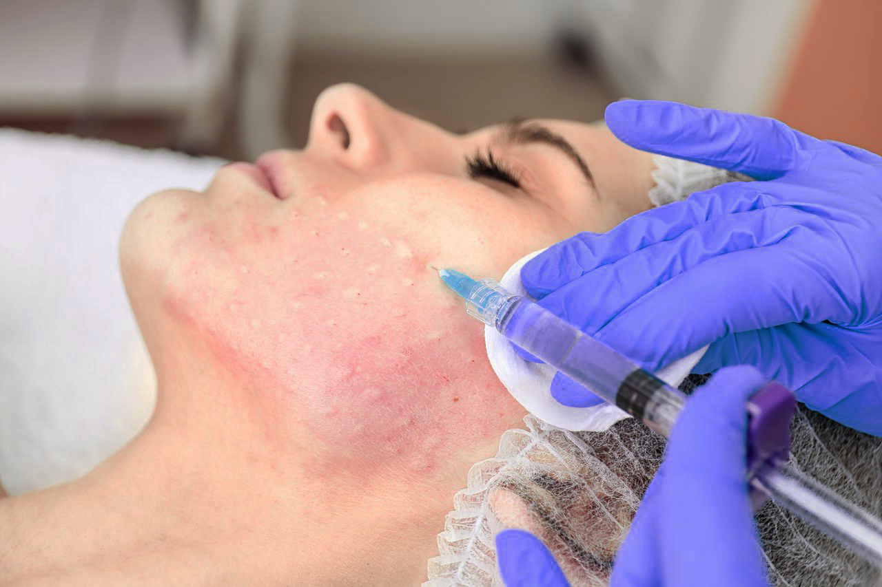 Мезотерапия лица: виды и особенности. этапы и области проведения. противопоказания и ослажнения