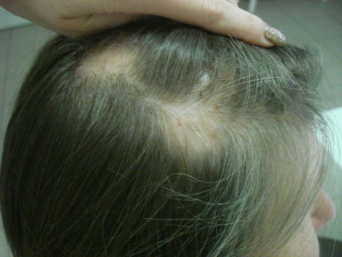 Алопеция: что это такое, причины, лечение выпадения волос