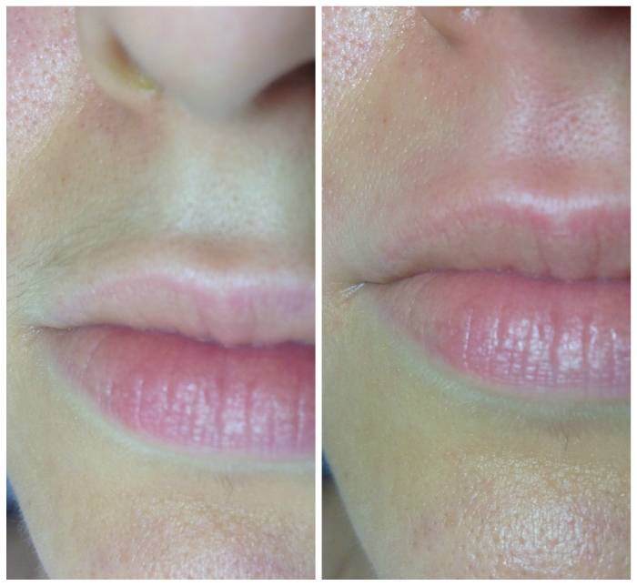 Что надо знать о лазерной эпиляции, прежде чем на неё решиться