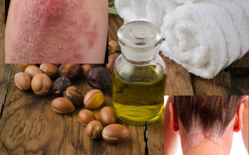 Псориаз народные средства лечения бабушкины рецепты • как вылечить аллергию