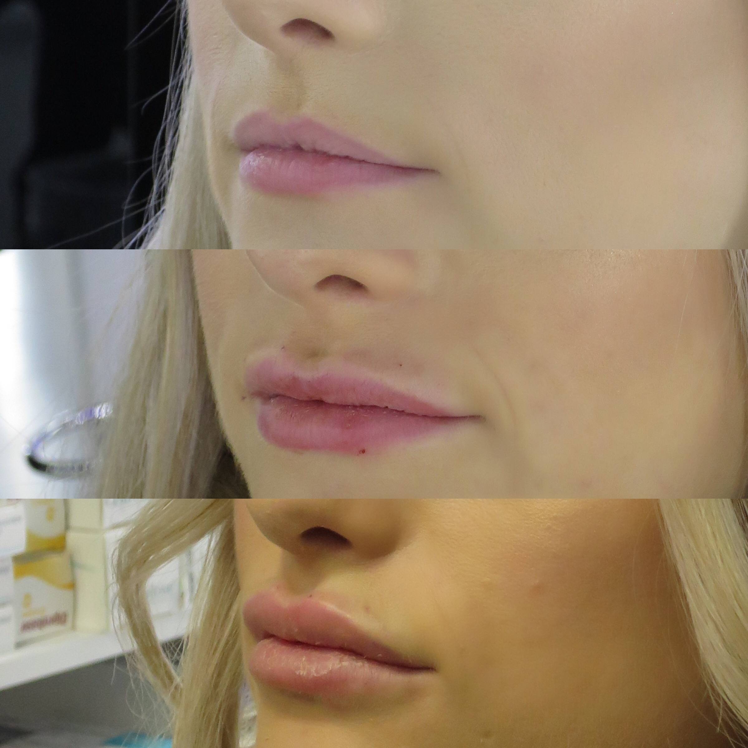 Техники увеличения губ с фото