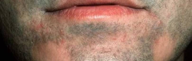 Что означают прыщи на лице: на носу, подбородке лбу, щеках