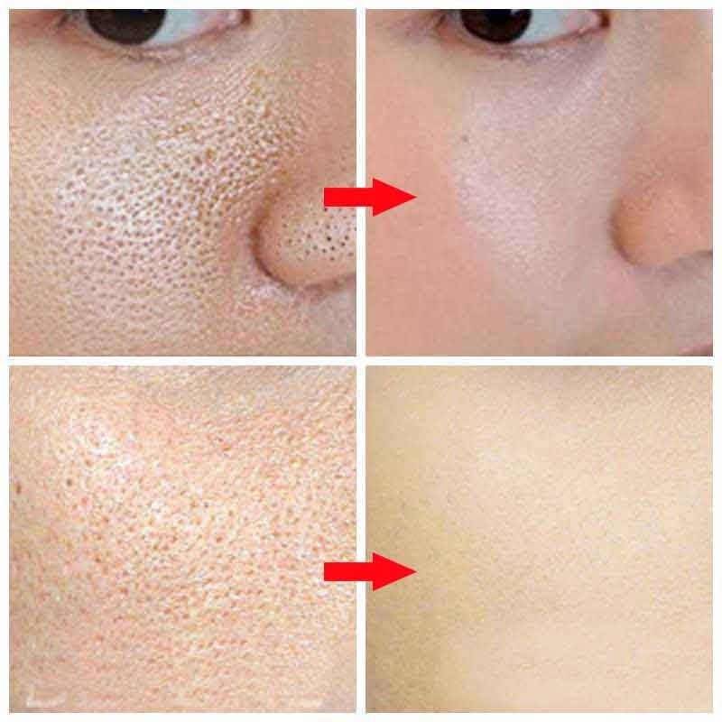 Расширенные поры на лице – лучшие решения для чистой кожи