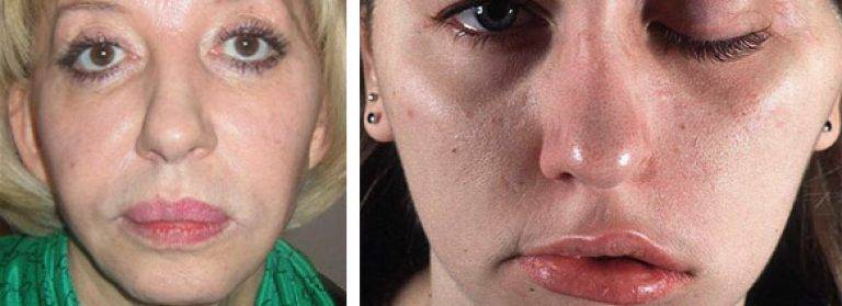 Аллергия на ботокс