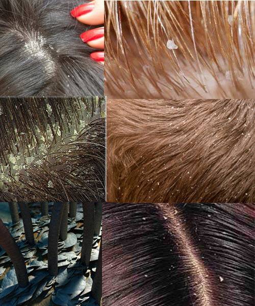 Народные средства от перхоти и выпадения волос: рецепты, действие компонентов, курс лечения и результаты