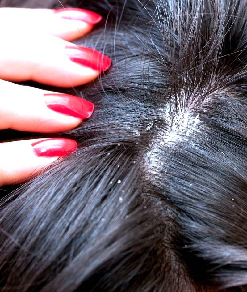 Перхоть (себорея) и выпадение волос: причины, симптомы и лечение, традиционные и народные средства