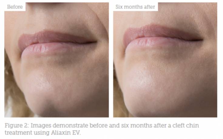 Как убрать «второй» подбородок и щеки: безоперационные и хирургические методики