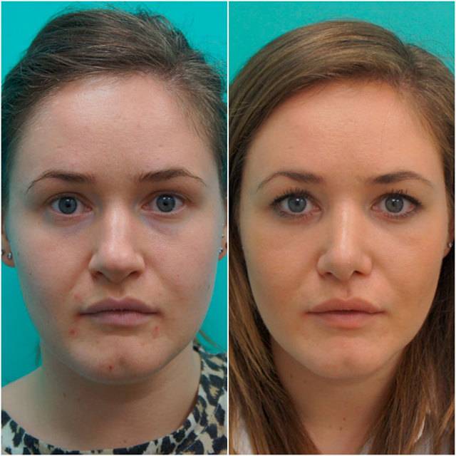 Безоперационная ринопластика в москве. коррекция носа без операции: филлерами и нитями. фото до и после