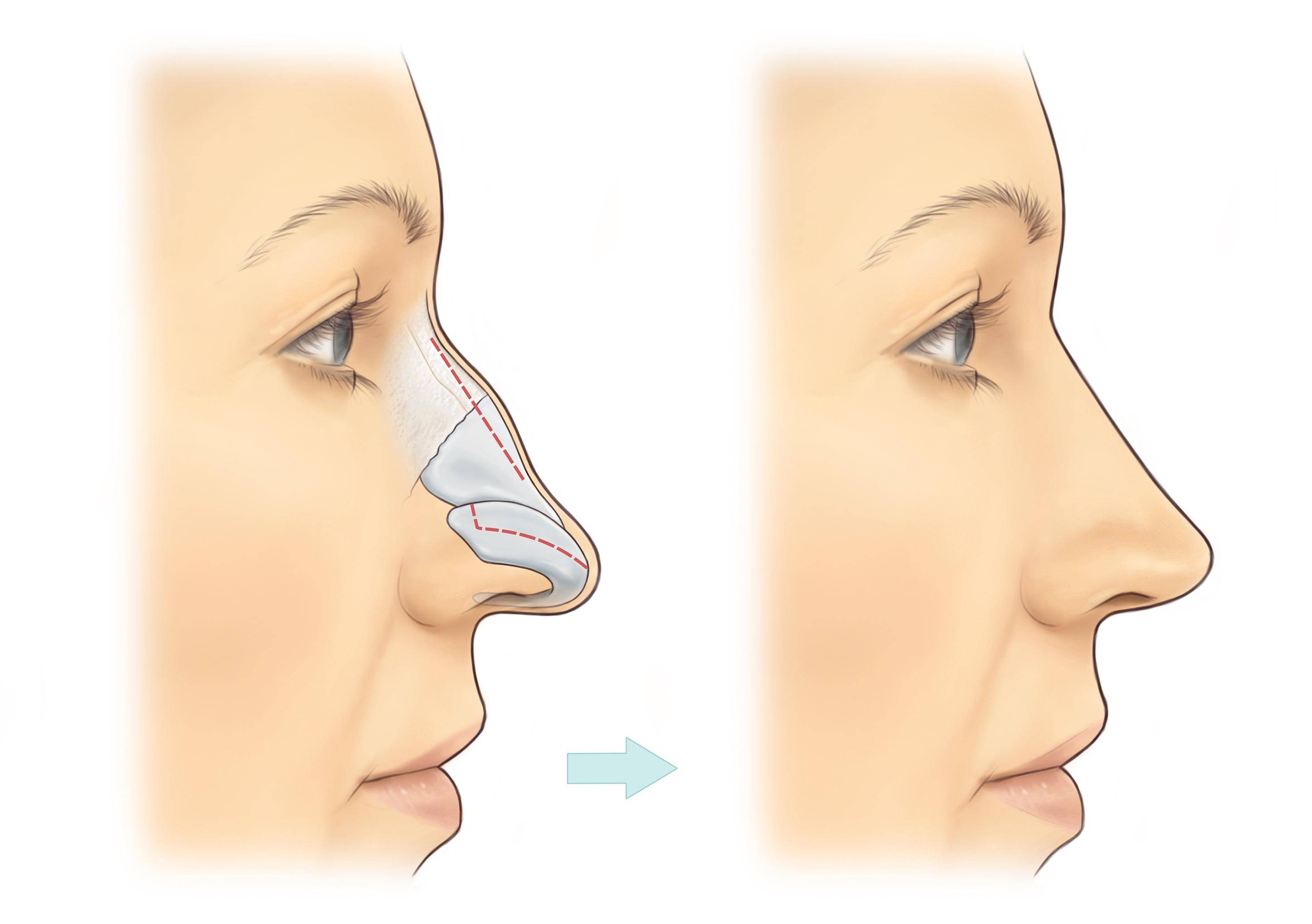 Операция на кончик носа