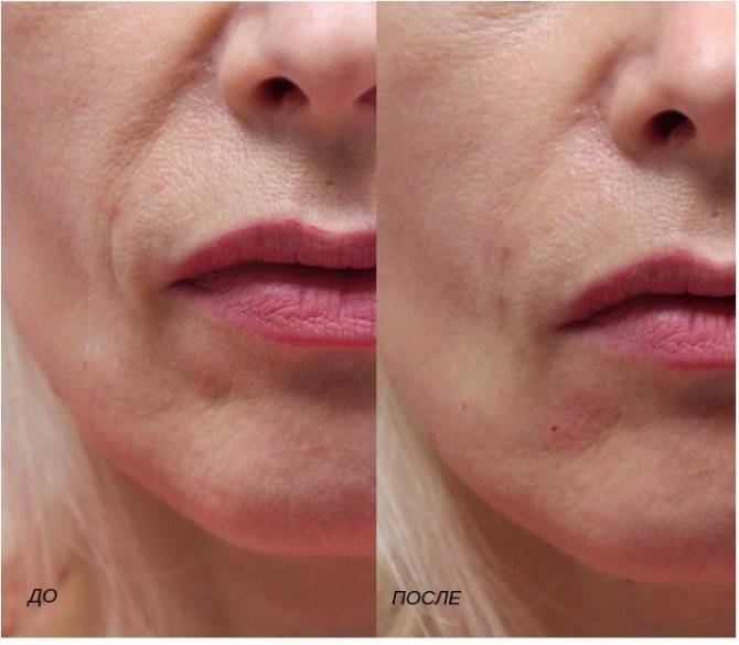 Сравнение двух методик омоложения: биорепарация или биоревитализация — что лучше?