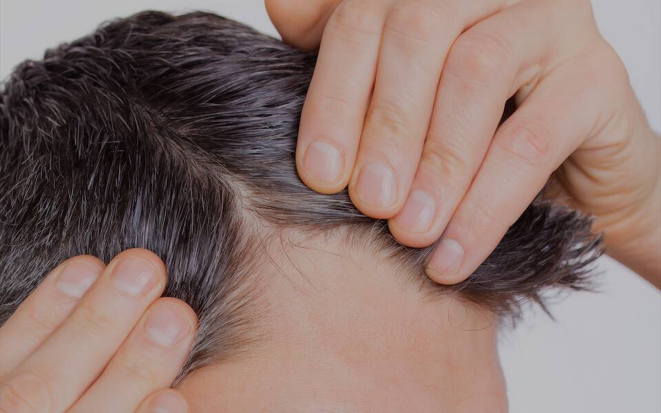 Что делать, если у мужчины выпадают волосы: причины облысения головы и методы борьбы с алопецией
