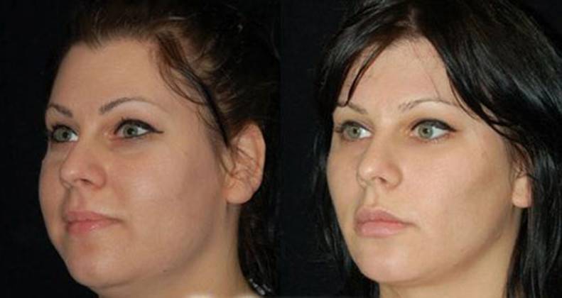 Что такое комки биша: плюсы и минусы их удаления. фото до и после операции