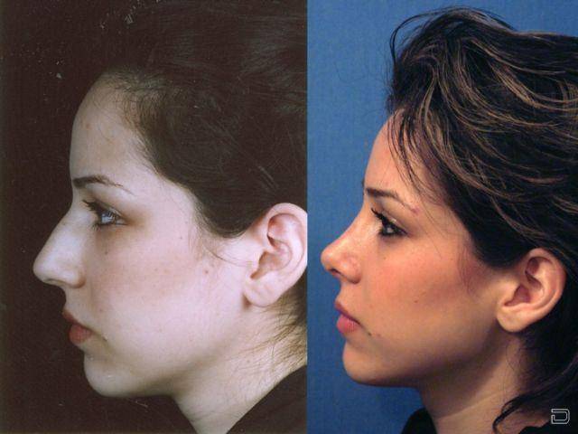 Ринопластика до и после фото девушек