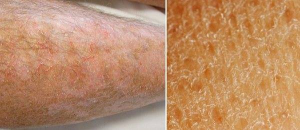 Почему кожа на ногах сухая и шелушится