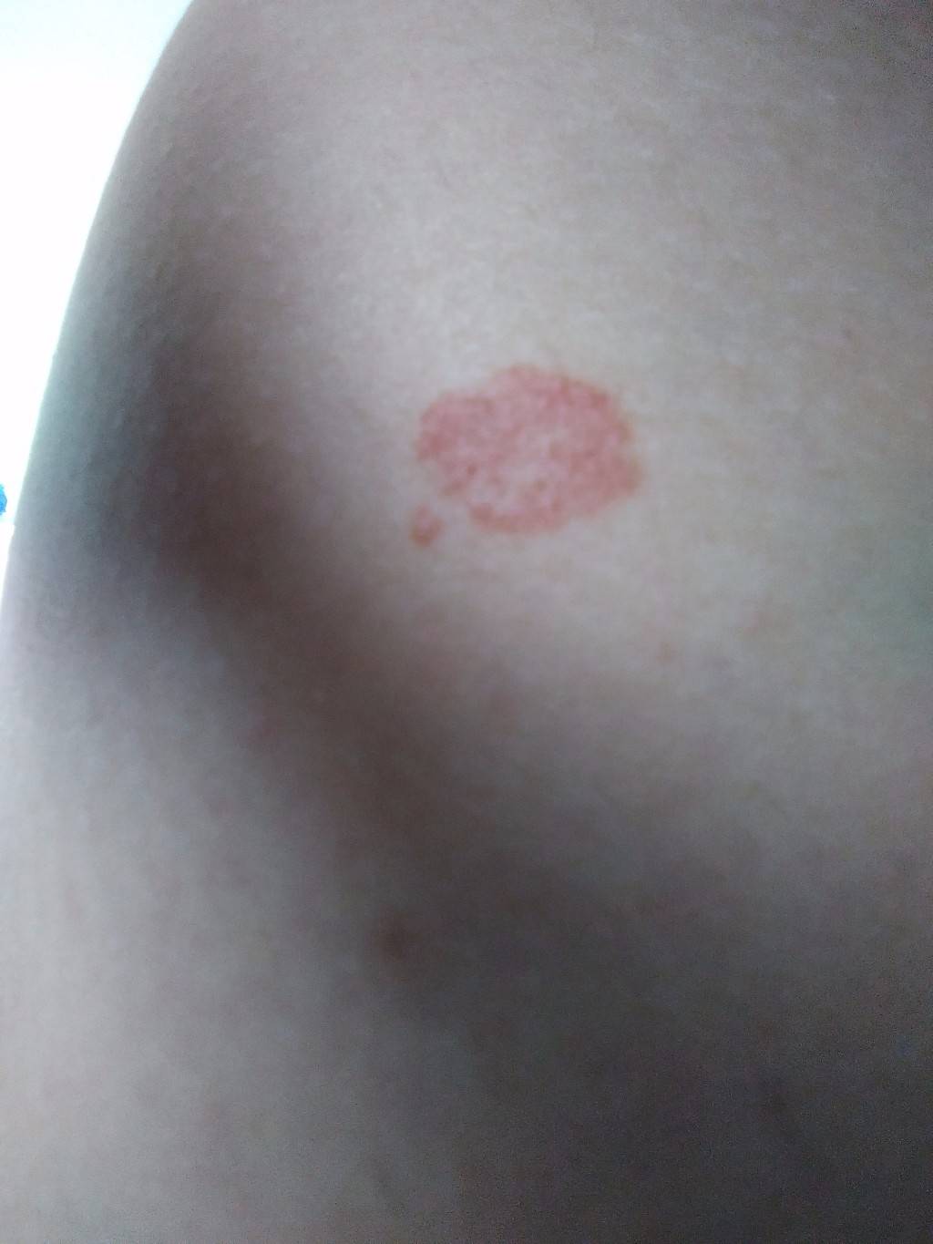 Красные пятна на теле: топ 5 причин у взрослых, названия болезней с фото