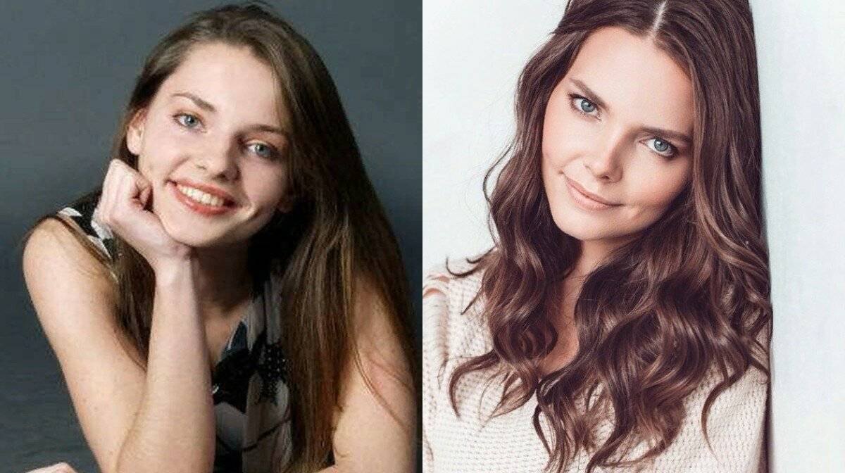 Боярская до и после пластики фото носа