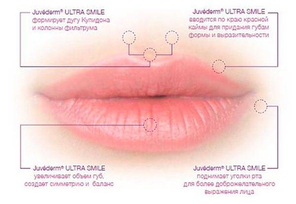 Парижская техника увеличения губ схема
