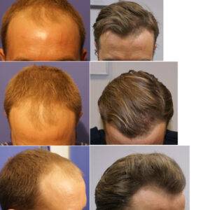 Пересадка волос на лицо методом hfe: процедура, результаты и стоимость