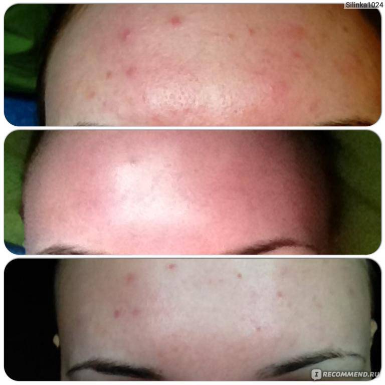 Пилинг бодягой и перекисью водорода для лица – все о чистке кожи, рецепты в домашних условиях