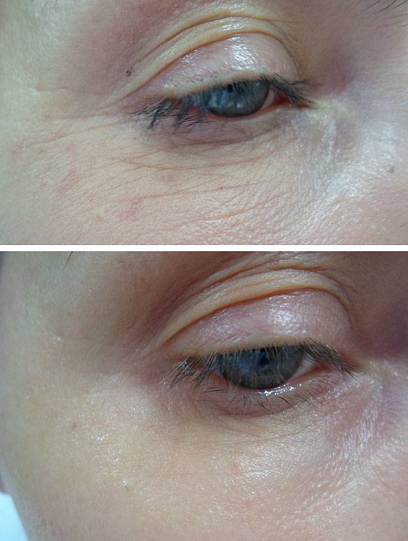 "дермахил" мезотерапия: основной состав, линейка препаратов для лица, волос, глаз, коктейли для головы