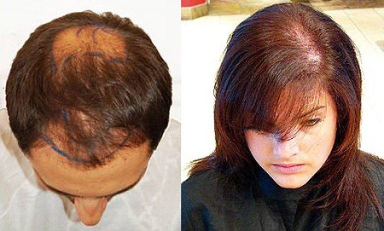 Выпадение волос: причины и лечение у женщин