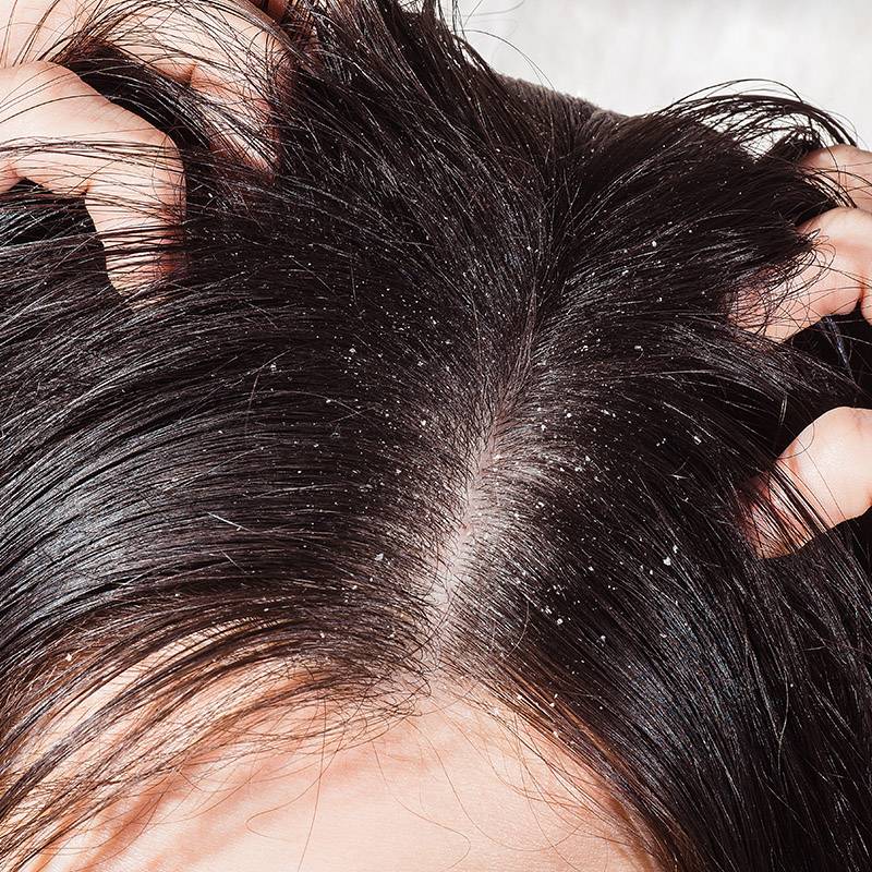 Перхоть и выпадение волос какие витамины принимать