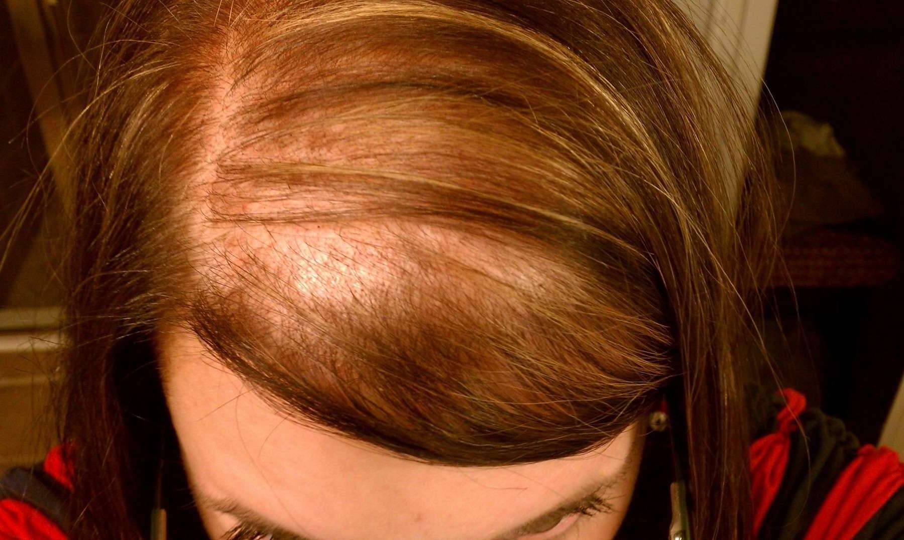 Выпадение волос у женщин: причины, лечение, средства