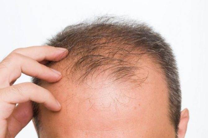 Сезонное выпадение волос у женщин: причины и лечение