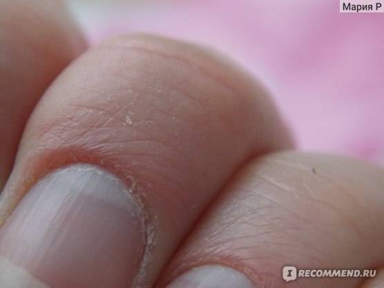 Что делать, если сохнет кутикула и кожа вокруг ногтей?