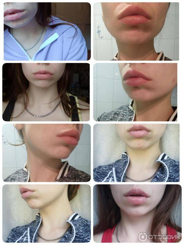 Инъекции гиалуроновой кислоты в губы: все тонкости процедуры, фото до и после