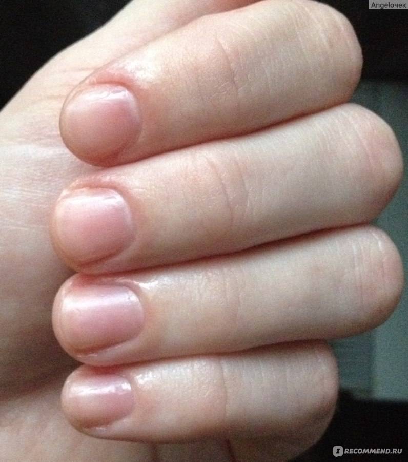 Воспаление кутикулы ногтя: лечение и причины