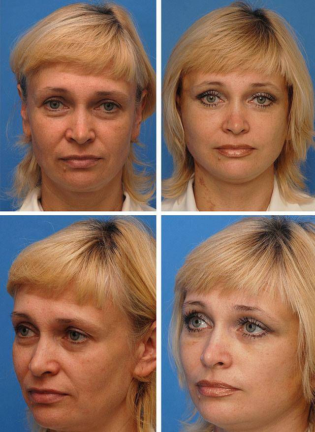 Подтяжка верхней трети лица фото до и после