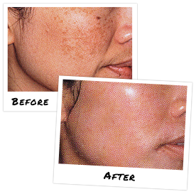 Поверхностно срединный пилинг аллюра эстетик gls * allura esthetics отзывы применения