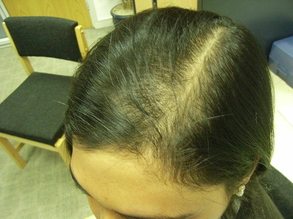 Выпадение волос при аднекситах