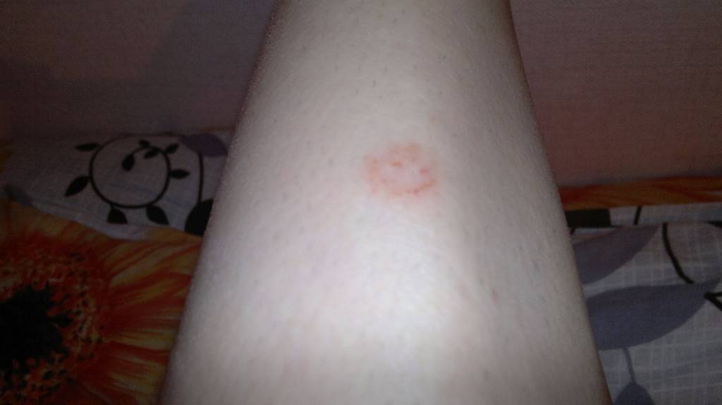 Красные пятна на коже, причины с фото и название болезни