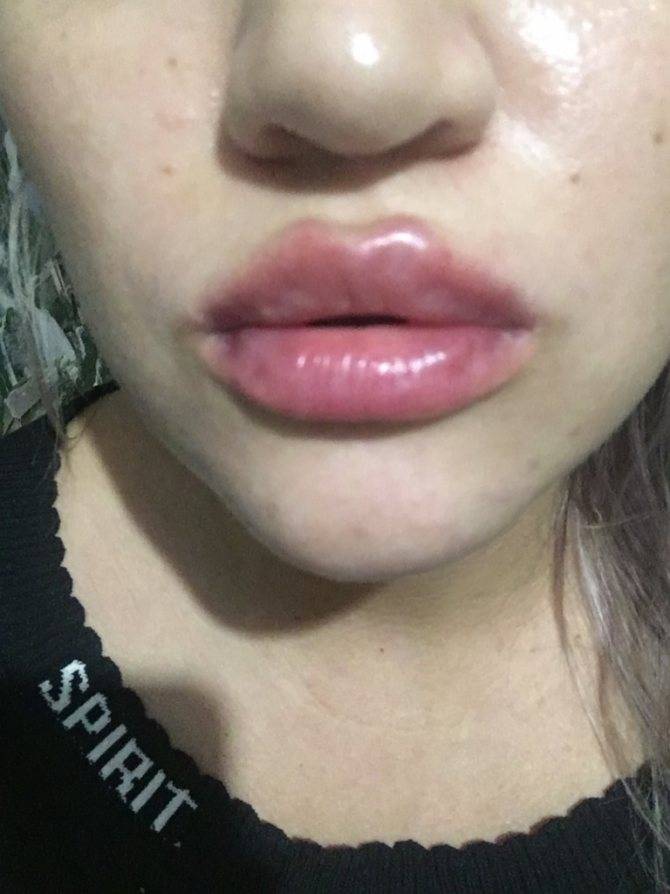 Чем мазать губы после увеличения гиалуроновой кислотой? | poudre.ru