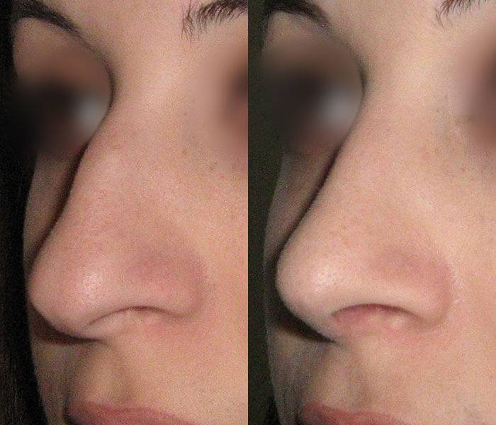 Горбинка на носу без операции. Ринопластика до и после. Ринопластика носа с горбинкой до и после. Ринопластика горбинки. Ринопластика горбинки и кончика.