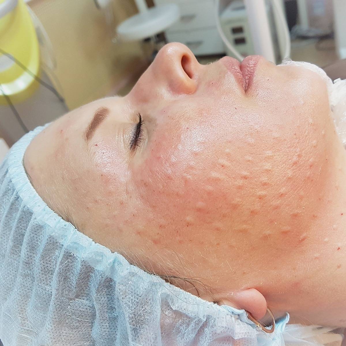 Мезотерапия лица: что это такое, какие используют препараты, сколько нужно процедур