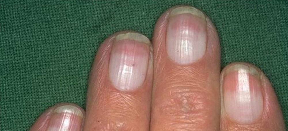 Определить болезнь по ногтям на руках фото