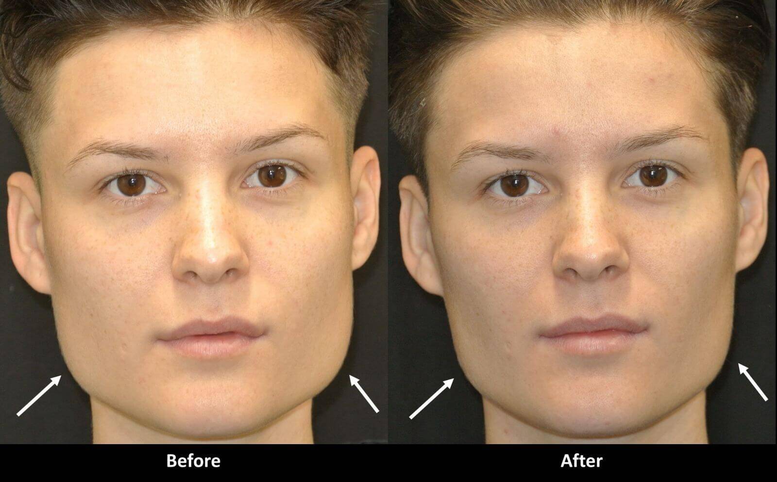 Резко изменилось лицо. Асимметрия лица. Мужские скулы до и после. Миотокс в жевательные мышцы. Ботокс для лица до и после.