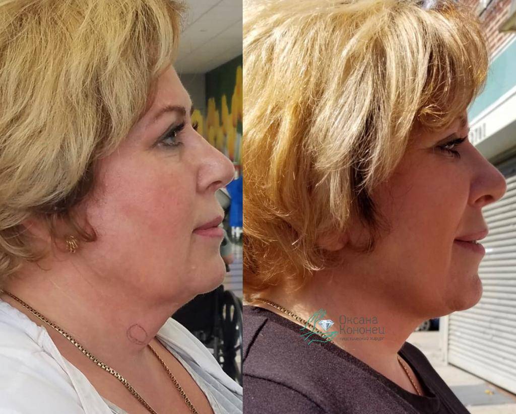 Липосакция подбородка, шеи и овала лица