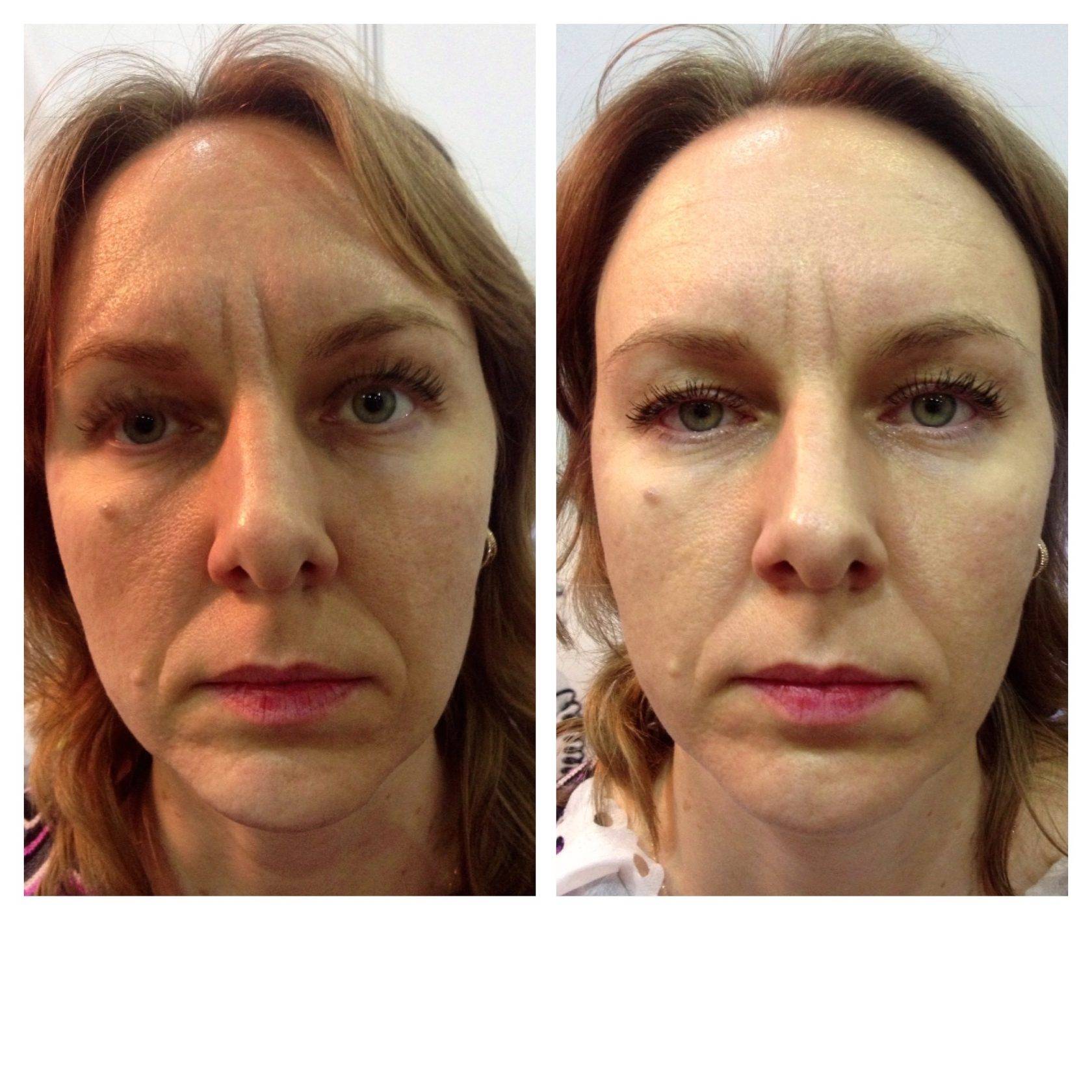 Сферогель в косметологии для глаз до и после фото