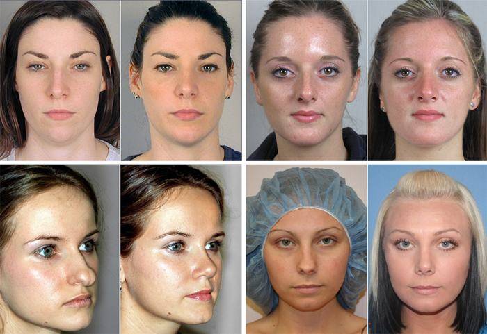 Операция на перегородку носа до и после фото