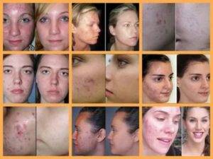 Синяки после биоревитализации: как быстро убрать и чем лечить гематомы | mfarma.ru