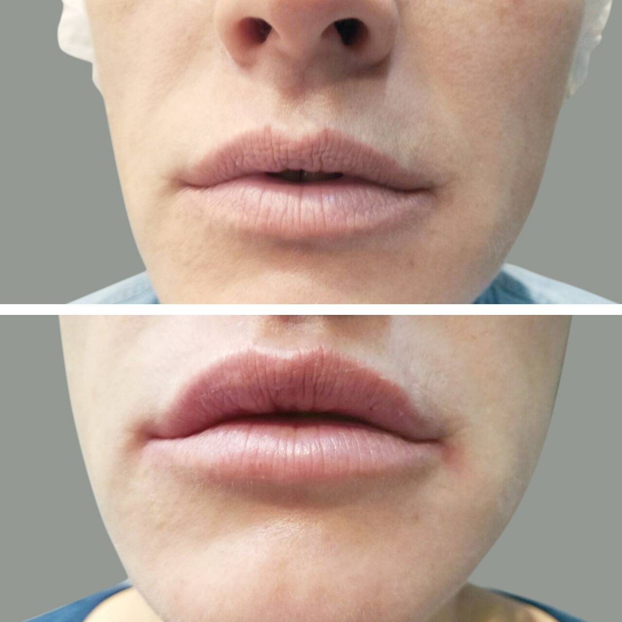 Губы до и после увеличения гиалуроновой кислоты. Коррекция губ. Уголки губ гиалуроновой кислотой. Контурная пластика губ гиалуроновой.