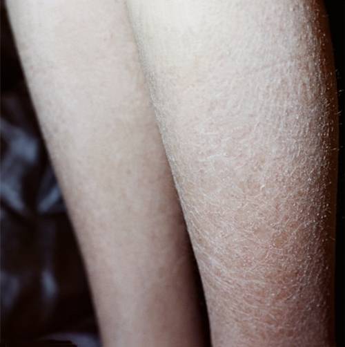 Каковы причины сухой кожи на ногах, методы лечения