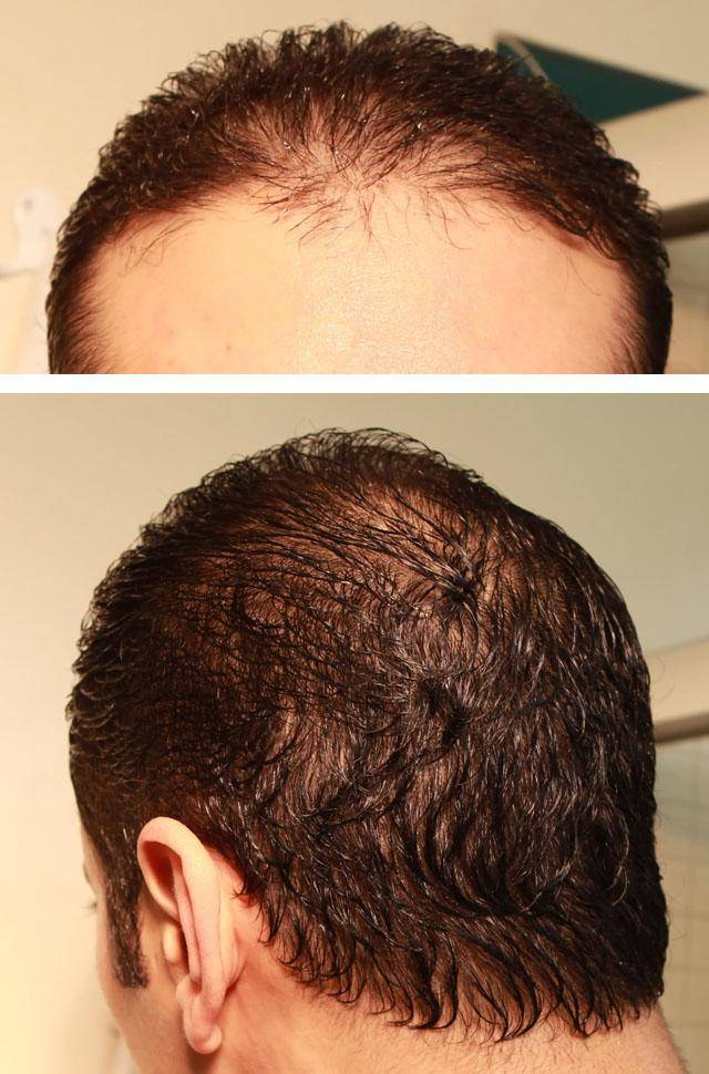 Что такое диффузное выпадение волос у мужчин